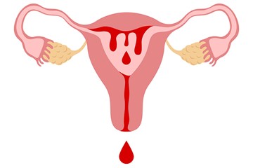 desenho de um sistema reprodutor feminino, com sangue menstrual saindo pelo canal vaginal